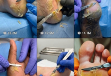 AI generated dead skin removal heel cleaning macro video tutorial